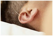 Auricular Acupuncture